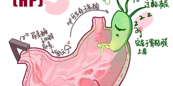 【必看】幽門螺桿菌真相揭示，別再忽視你的胃痛了！