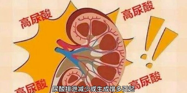 突然痛風？別再只怪啤酒和燒烤！真正的“尿酸元兇”遠比你想的多！